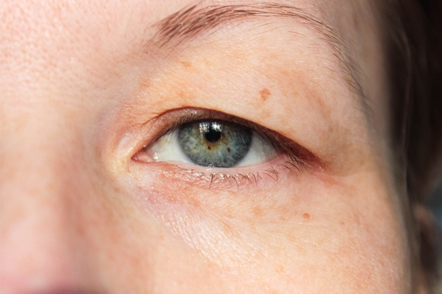 Double Eyelid Surgery Can Give You Beautiful Eyes If You Get Consulted Correctly